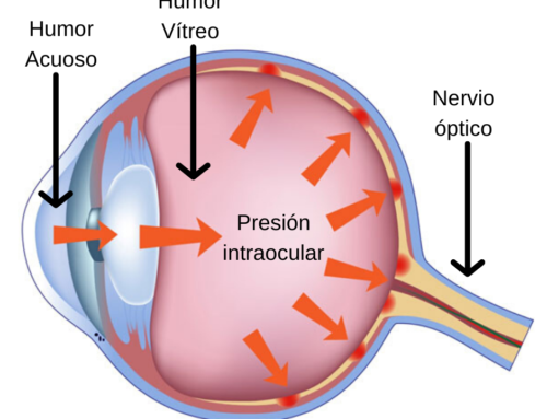 ¿Es lo mismo hipertensión ocular que glaucoma?