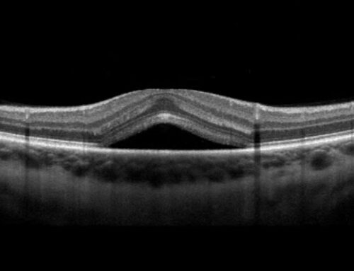 ¿Qué es Retinopatía Central Serosa?